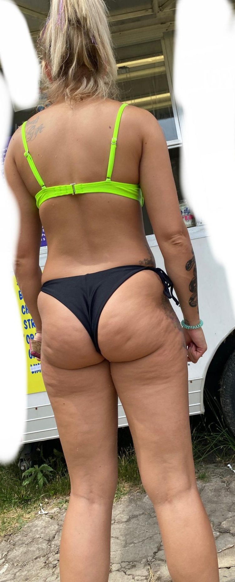 Lipodistrophy cellulite