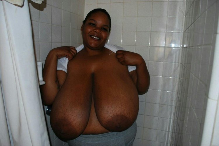 Macromastia gigantomastia