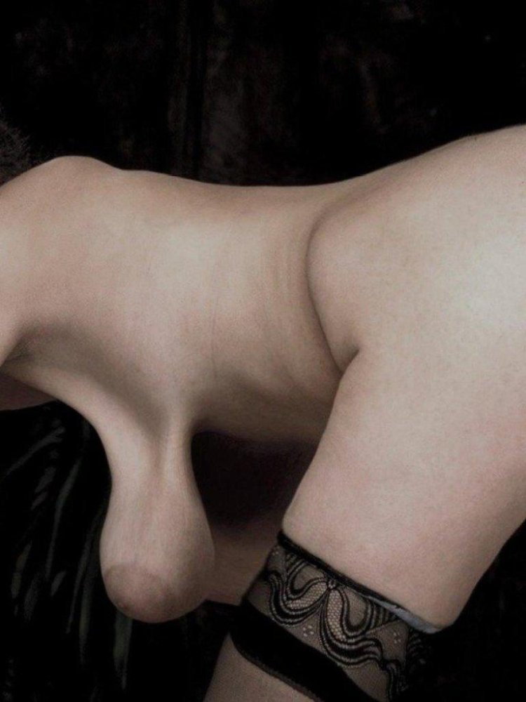 Fibrosteal mastopathy Mammography