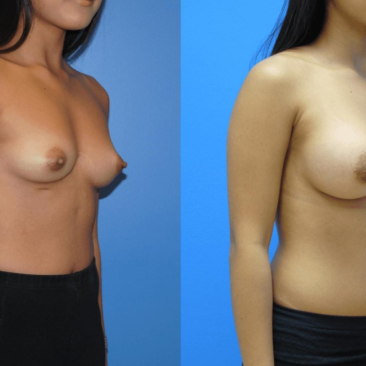 Elubicated female breasts