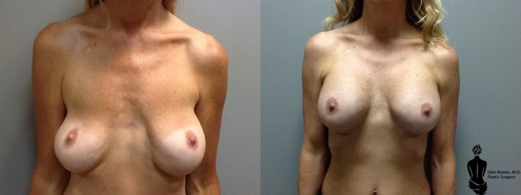 Before and after breast augmentation