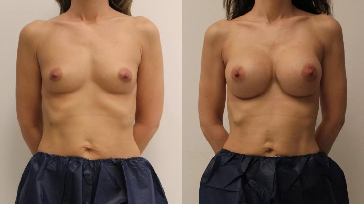 Gynecomastia liposuction