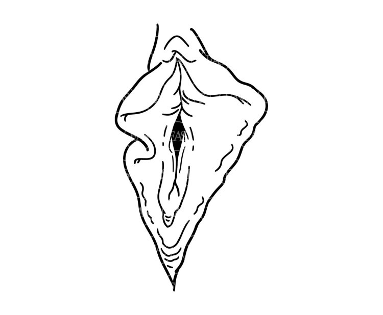 Labioplasty of a small labia