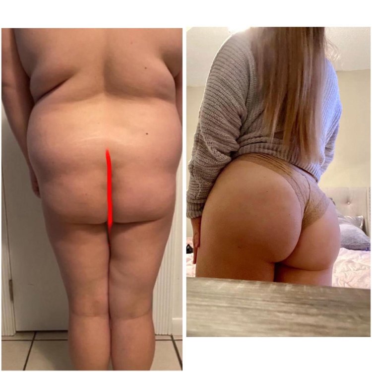 Gluteoplasty of the buttocks