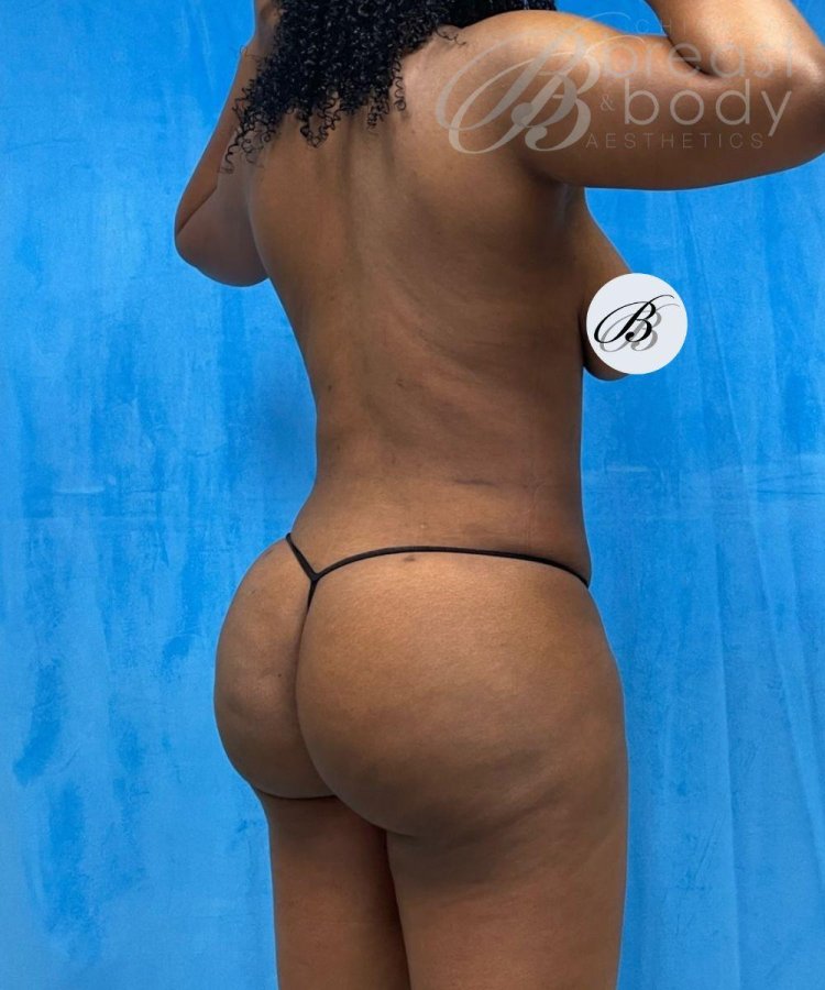 Lipofilling of buttocks asymmetry