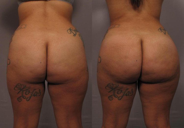 Lipofiling cellulite
