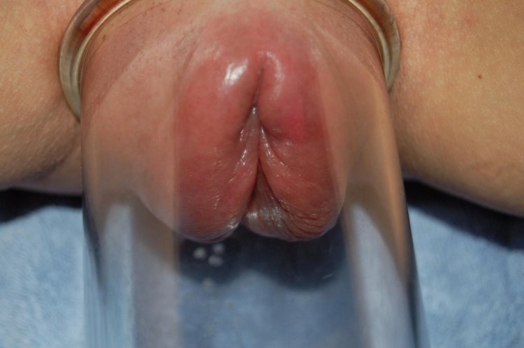 Vagina after vacuum Pumps