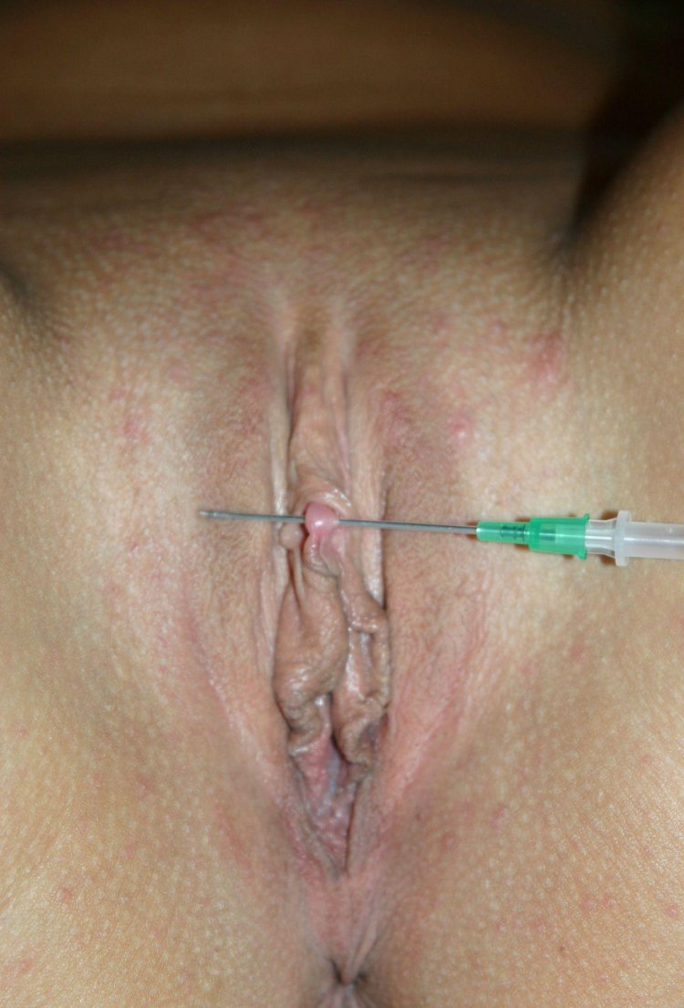 Piercing of the clitoris hood