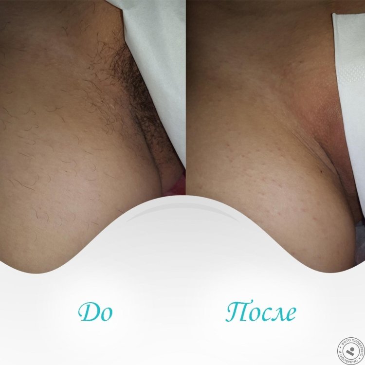 Epilation of the pubis before and after