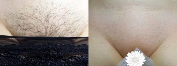Bikini Epilation
