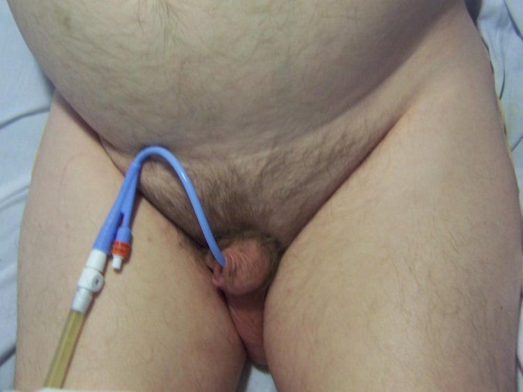 Catheter Foley Erotic
