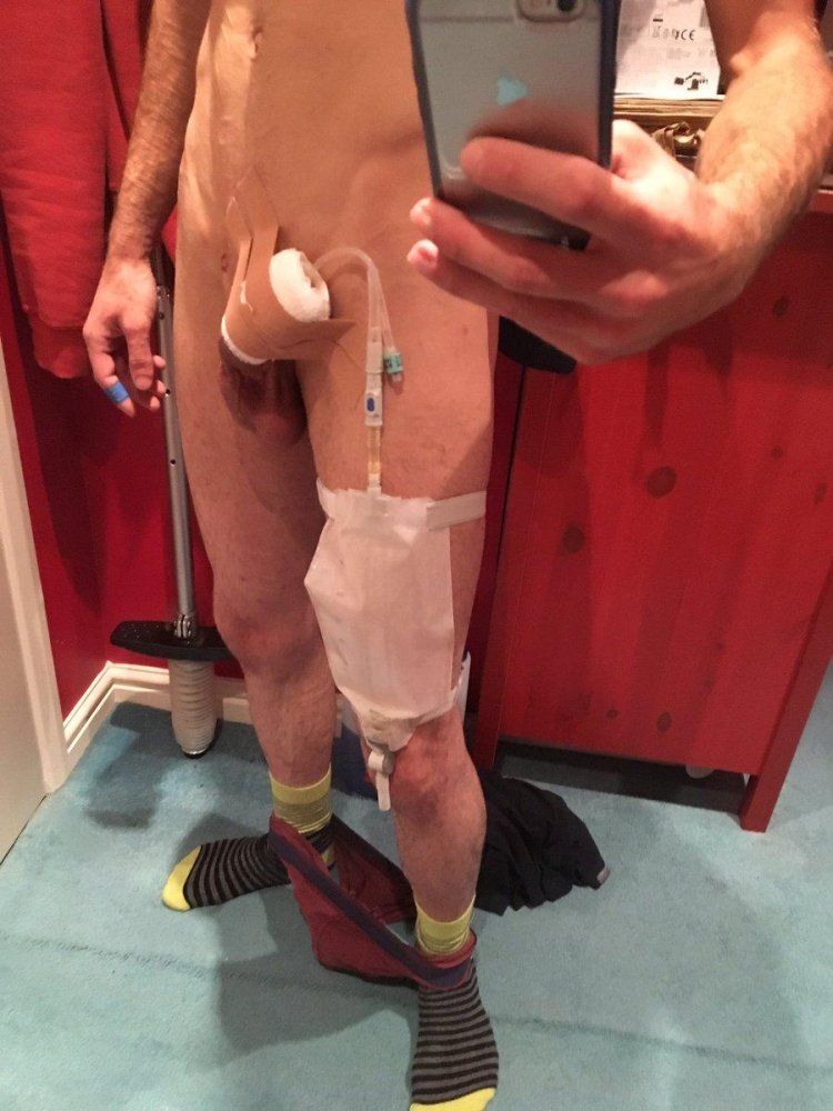 A teenager with catheter in dick