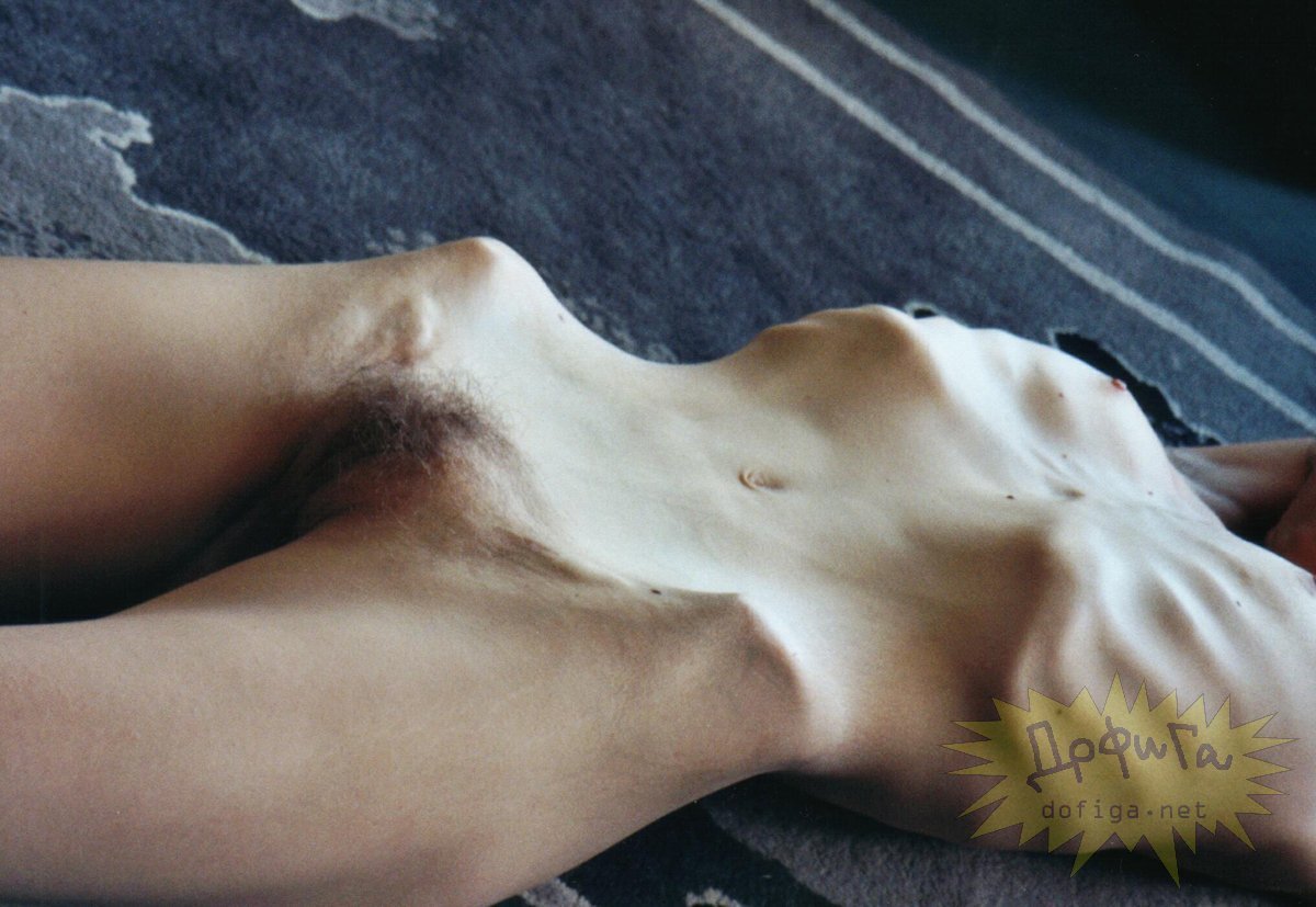 Anorexic Nude Girl.