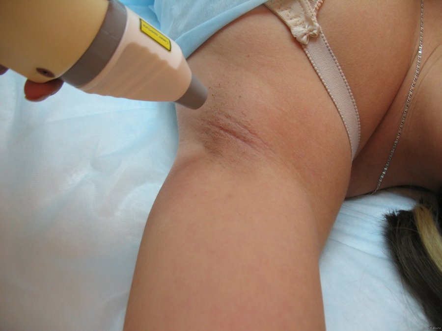 Depilation of the female perineum