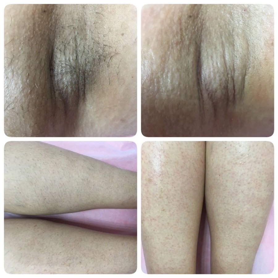 Laser vaginal hair removal