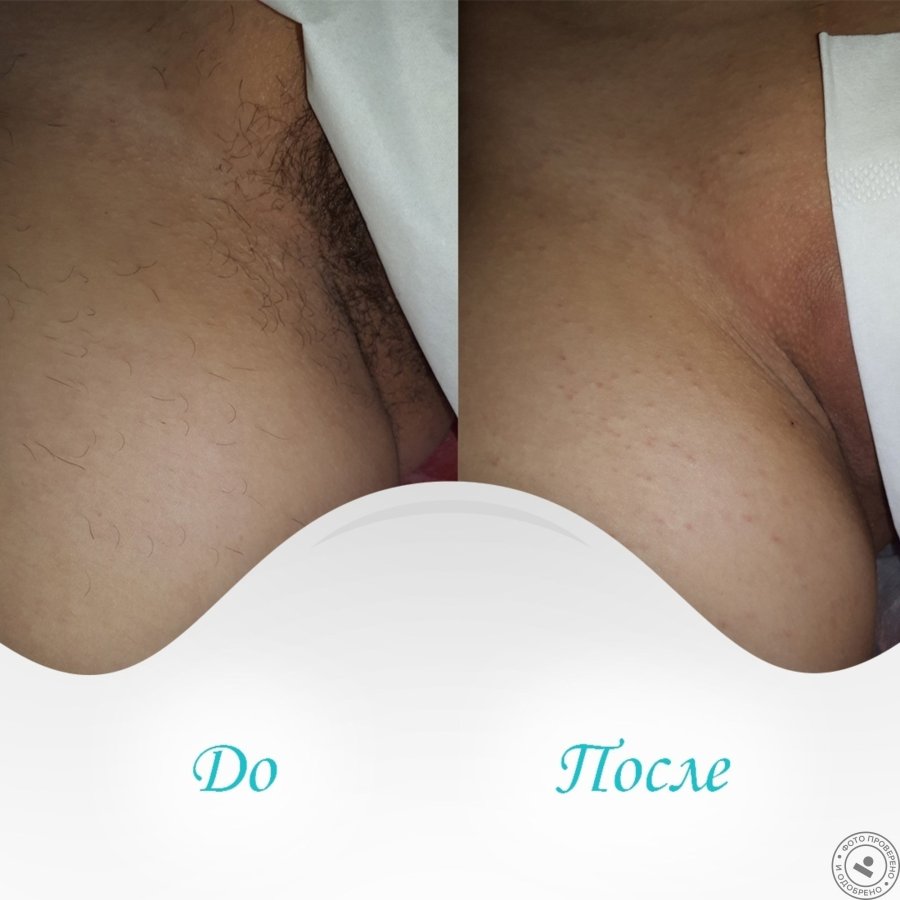 Pubic hair removal before and after