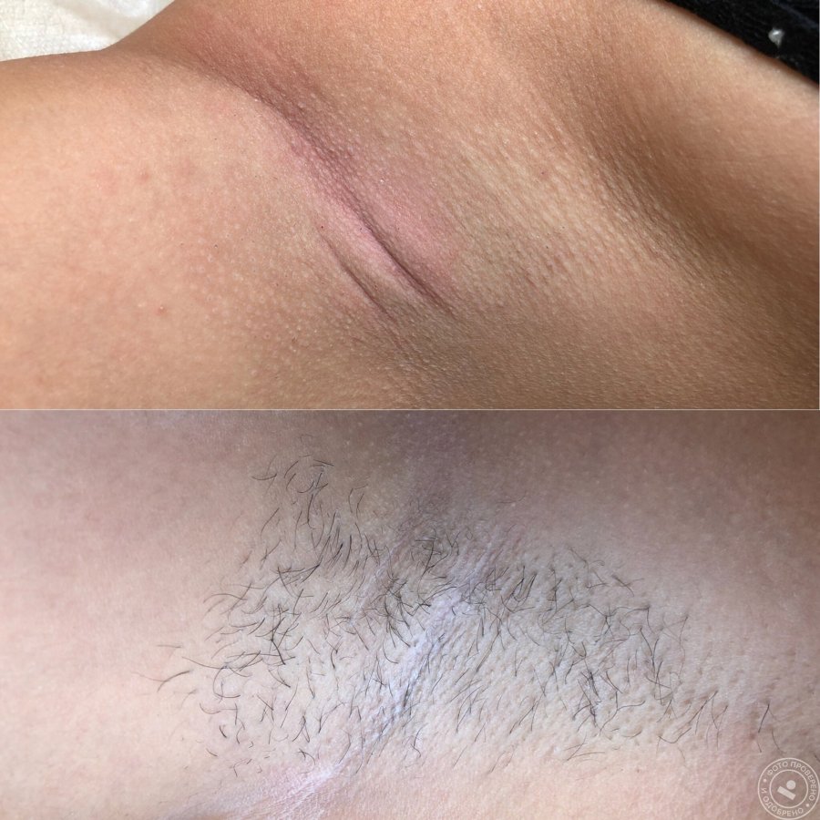 Deep bikini hair removal