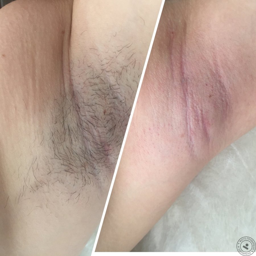 Deep bikini hair removal